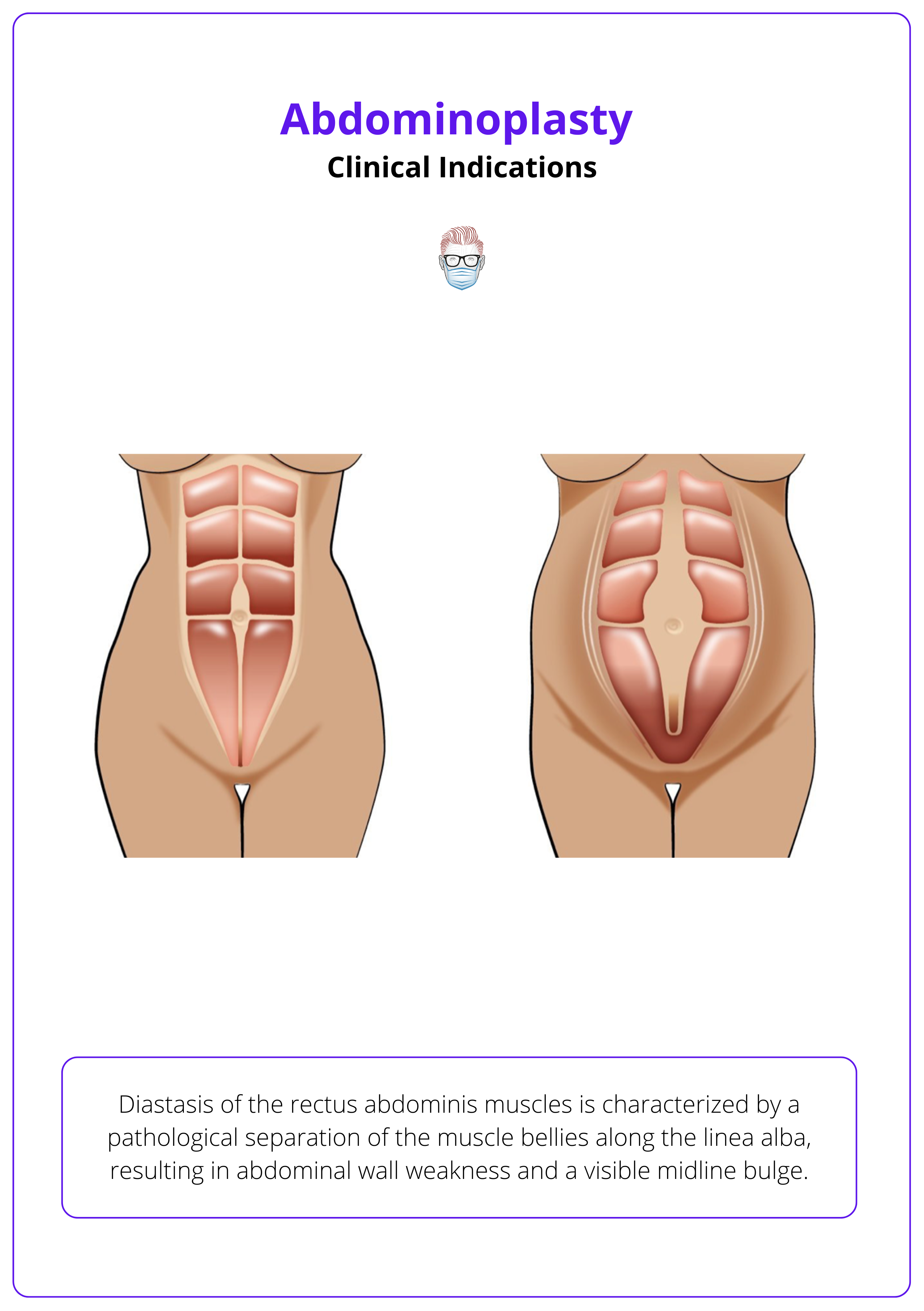 Diastasis of the rectus abdominis muscles, clinical indications for abdominoplasty
