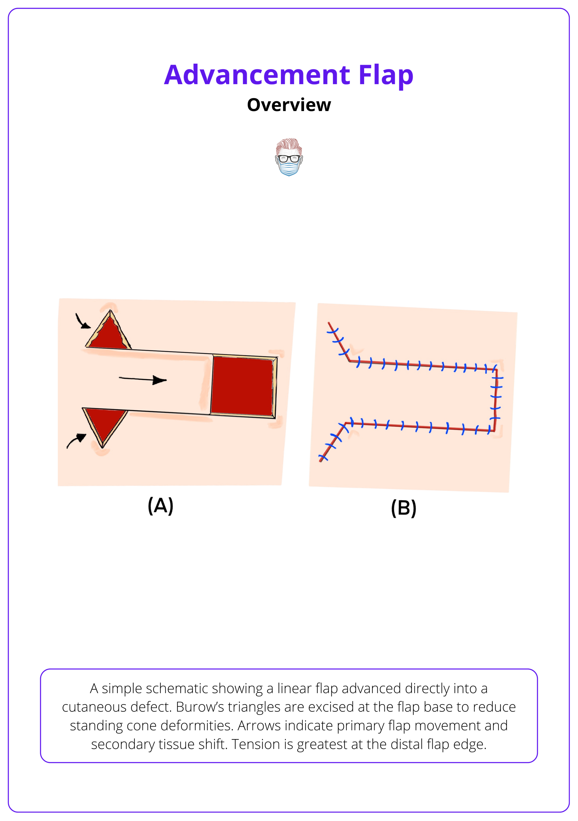 Linear advanced flap advanced directly into a cutaneous defect