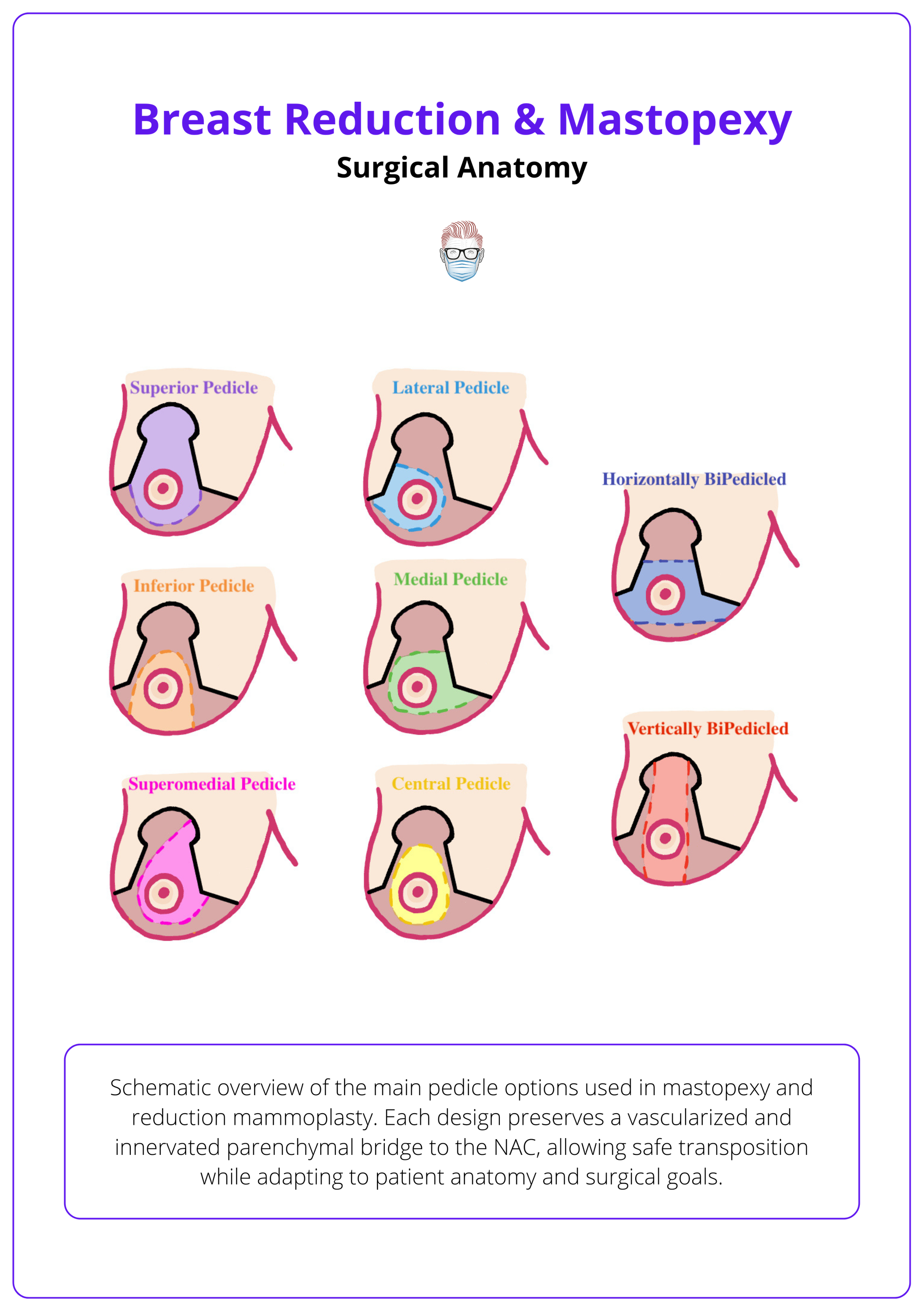 Key pedicle options used in mastopexy and reduction mammoplasty