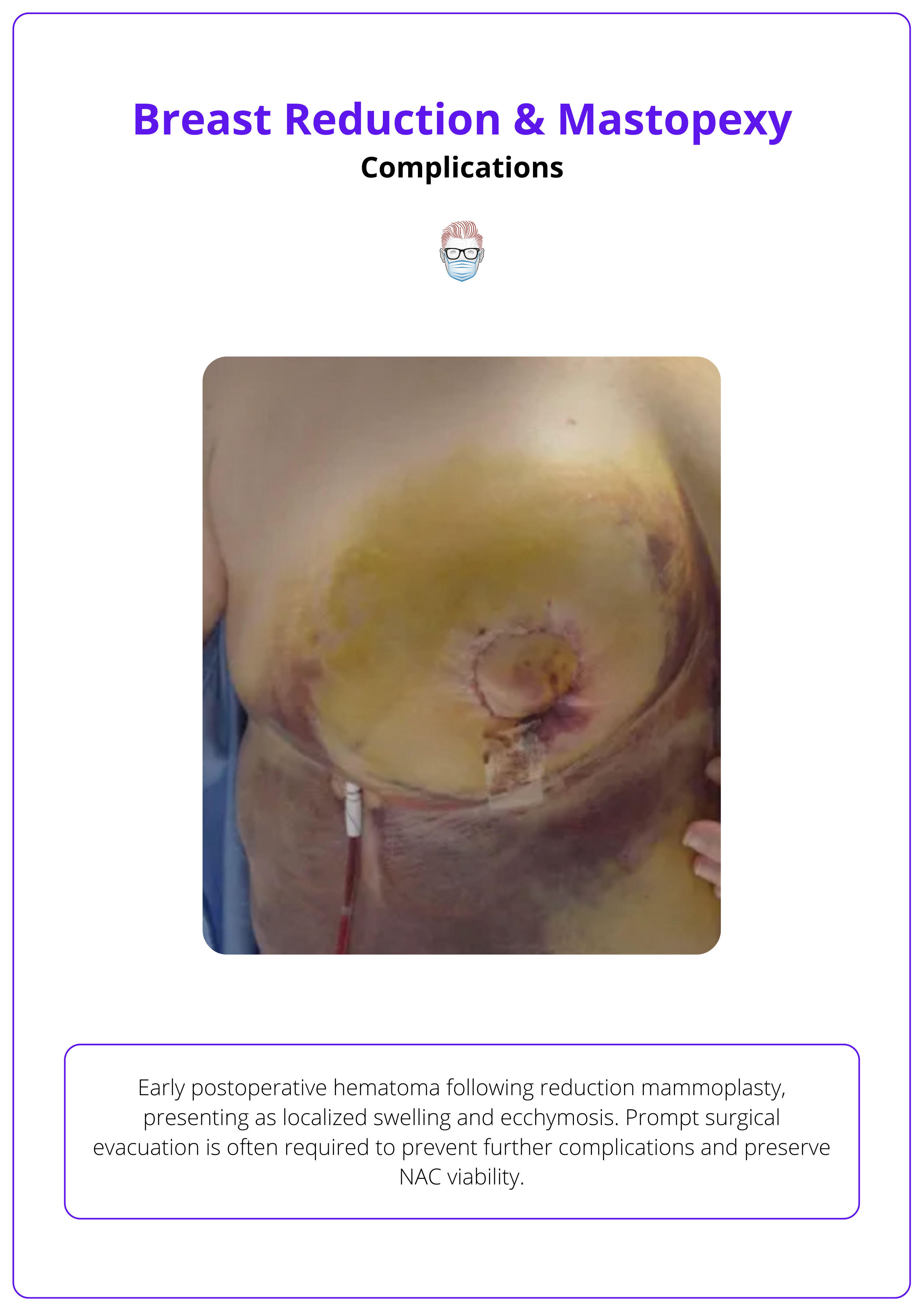 Early postoperative haematoma following reduction mammoplasty