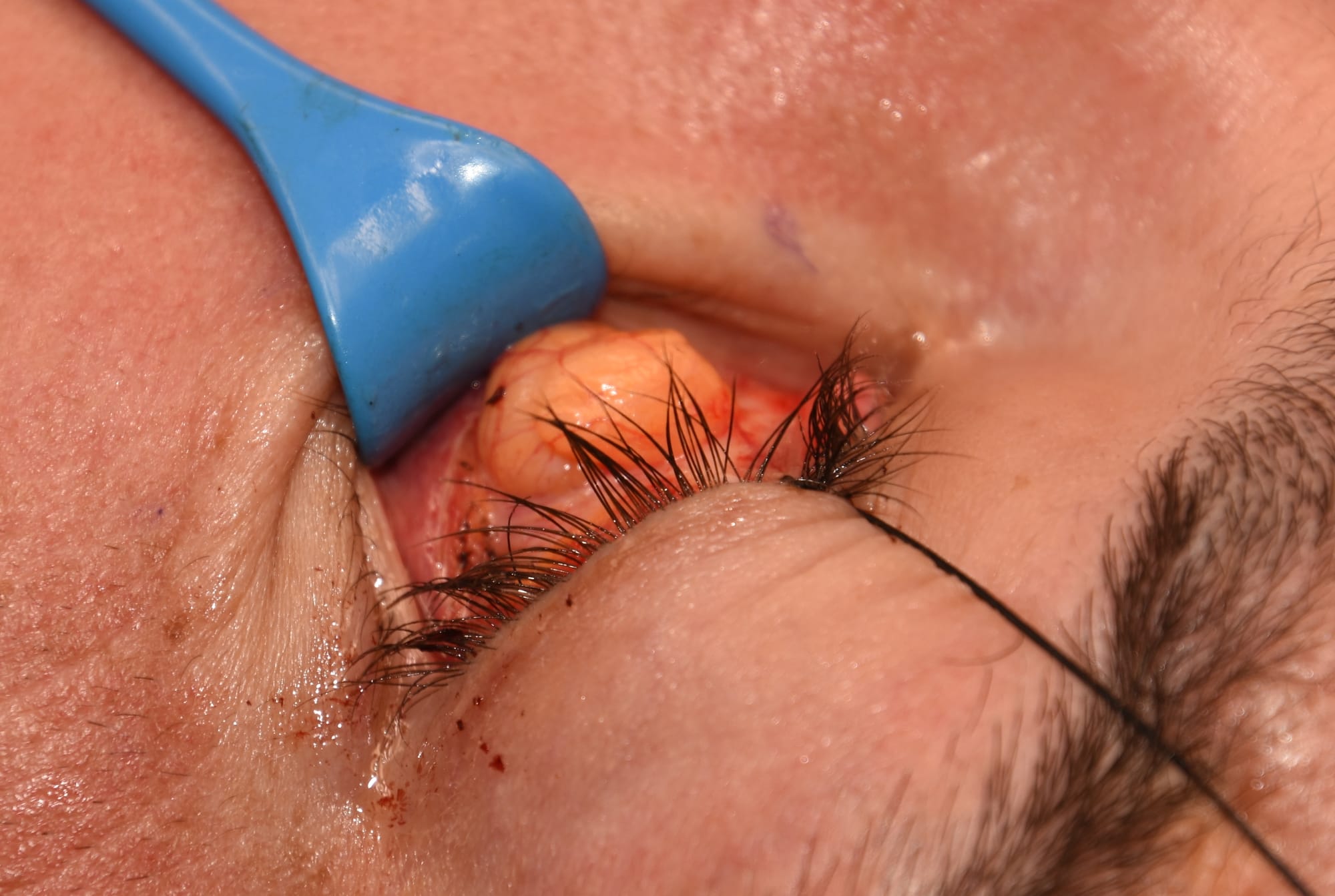 Intraoperative view of a transconjunctival lower eyelid blepharoplasty