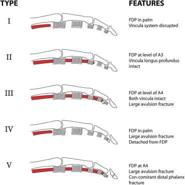 FDP Avulsion Injury Classification