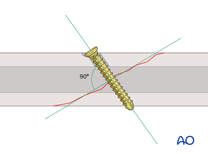 Lag Screw Fixation at 90°