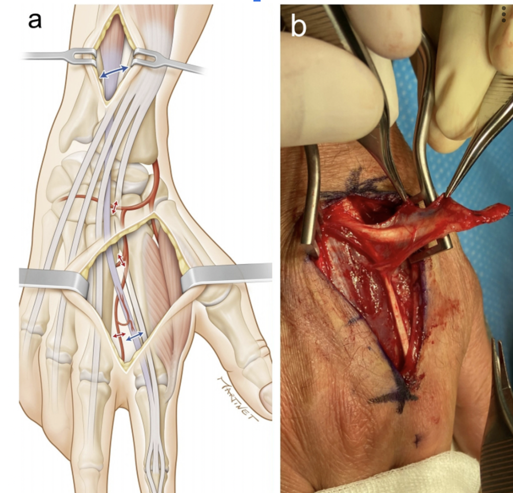 Extensor Retraction in Dorsal Hand Surgery