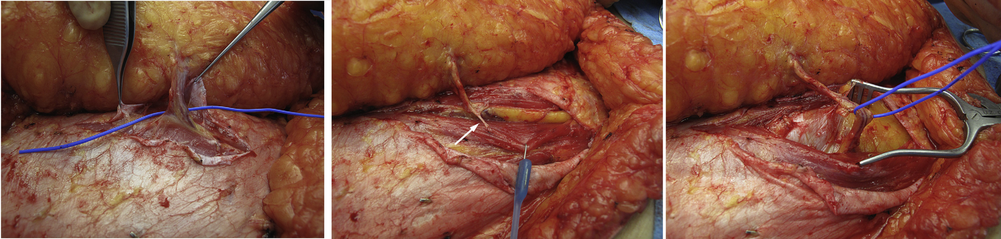 How to Dissect Perforator - Source