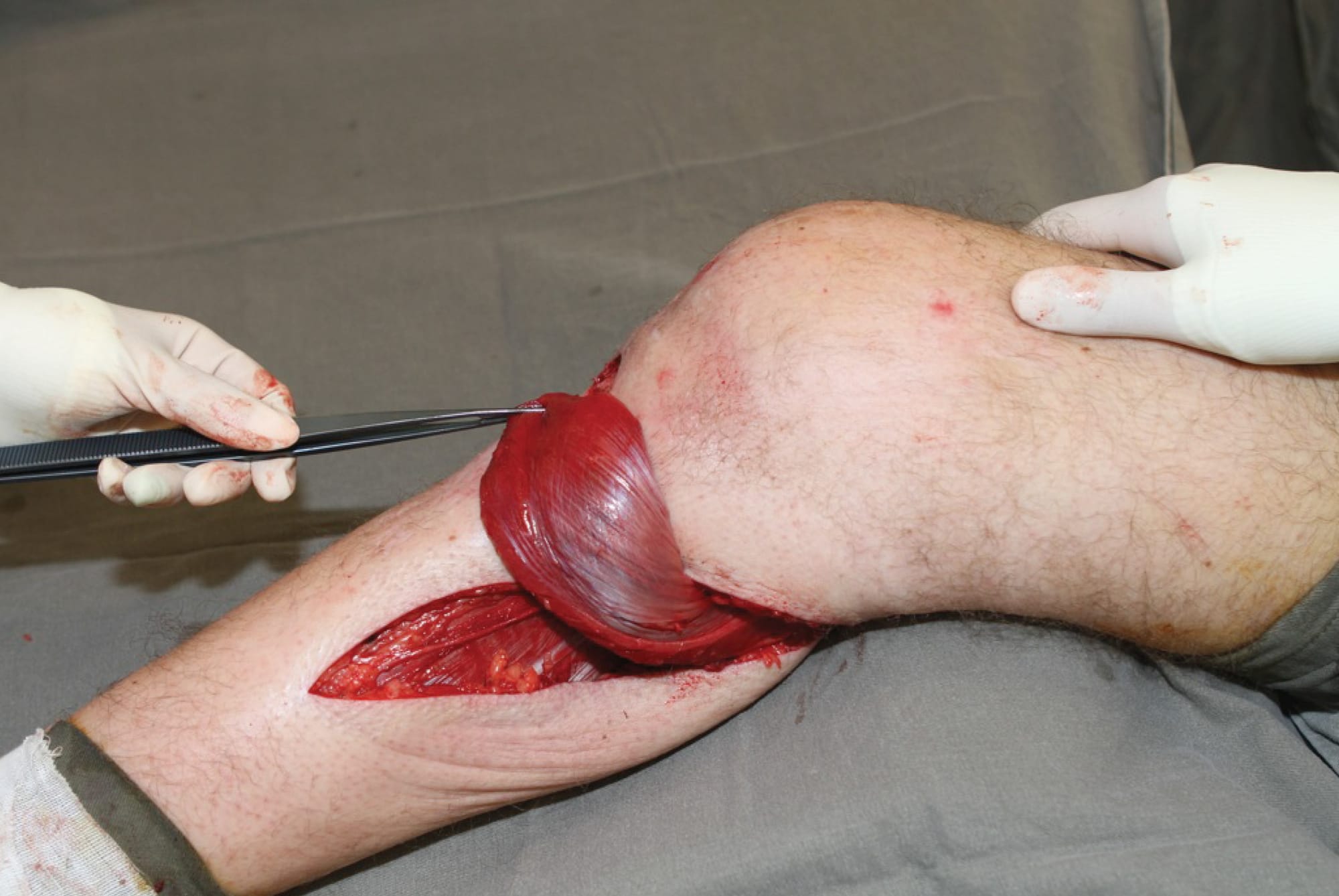 The medial gastrocnemius flap - lower limb reconstruction