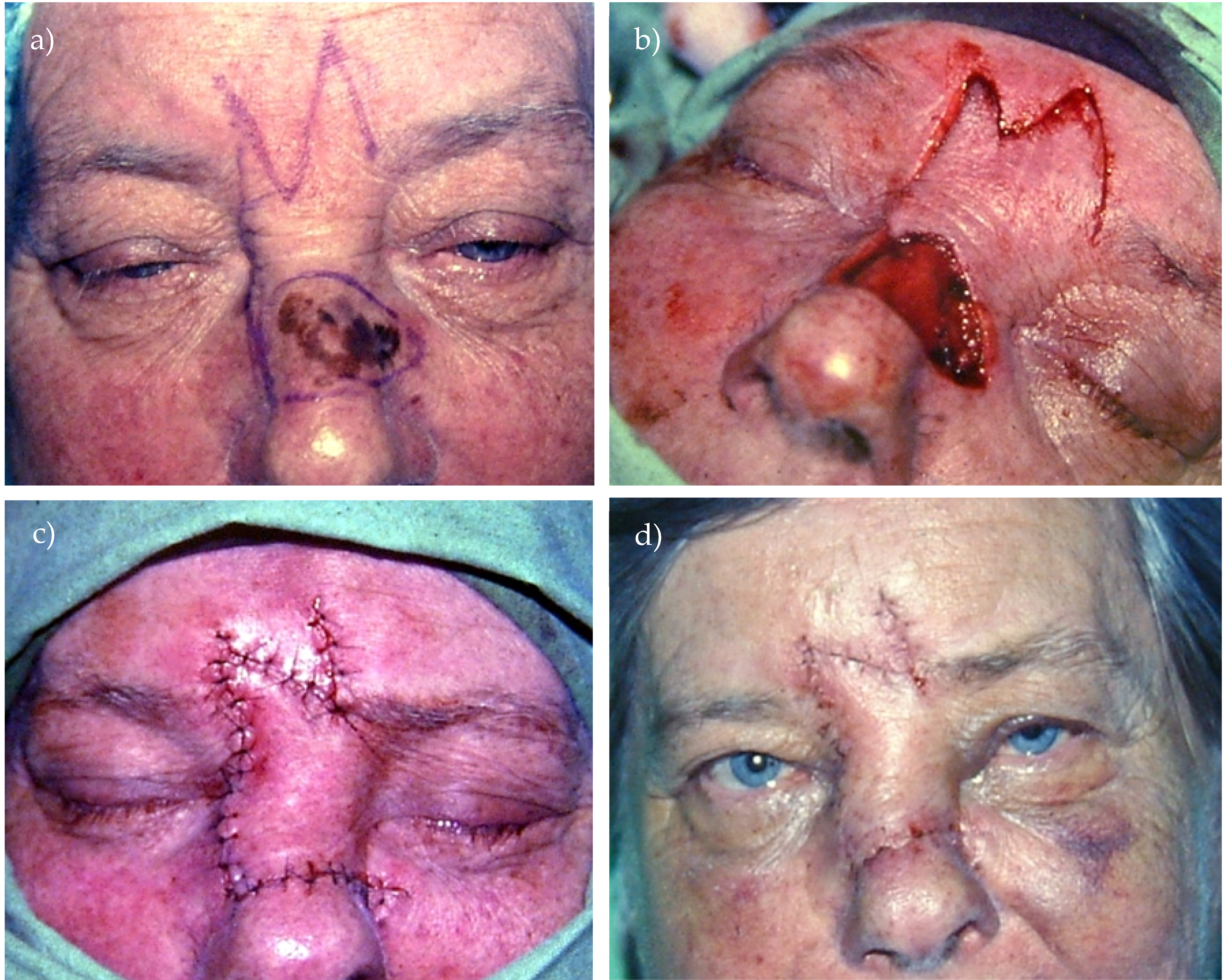 Glabellar Flap for Melanoma Reconstruction