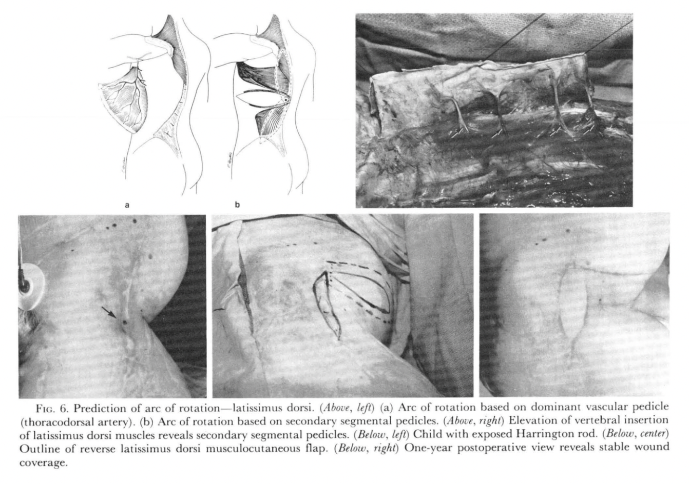 Latissimus Dorsi Flap - Source: Mathes and Nahai, 1981
