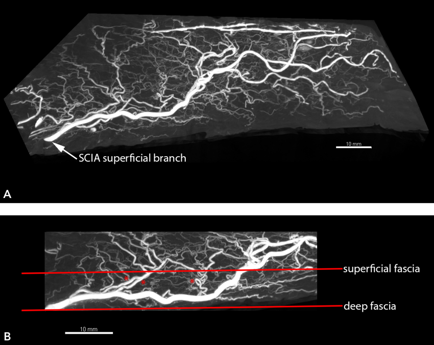 The Superficial Circumflex Iliac Artery in Detail