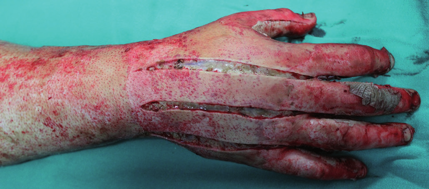 Escharotomy of the dorsum of the hand 
