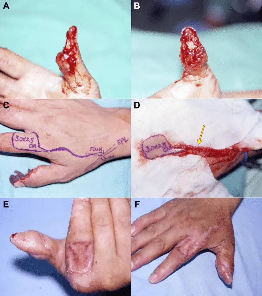 FDMA Flap: Sensate Thumb Reconstruction