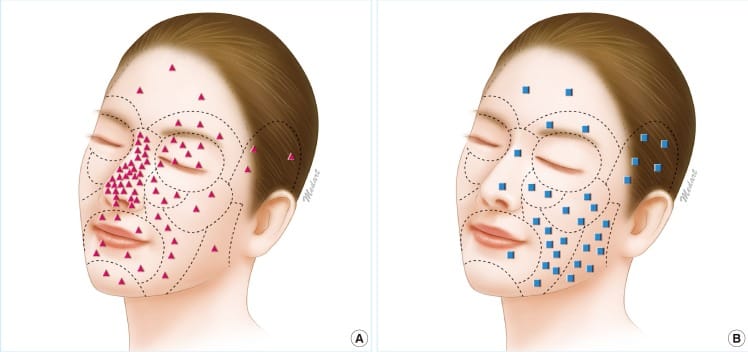 Distribution of basal cell carcinoma on the face