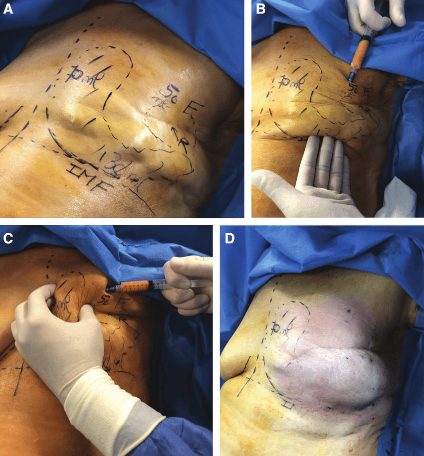 Fat Grafting: Strategic Lipofilling