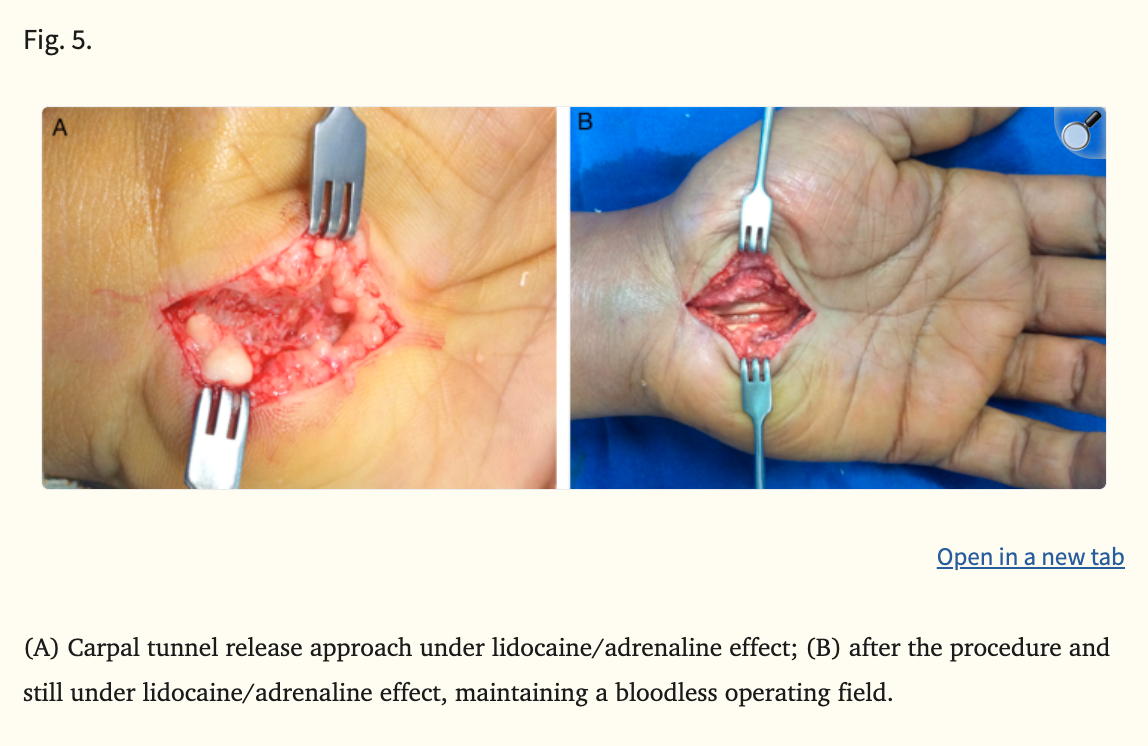 Carpal tunnel release performed under WALANT