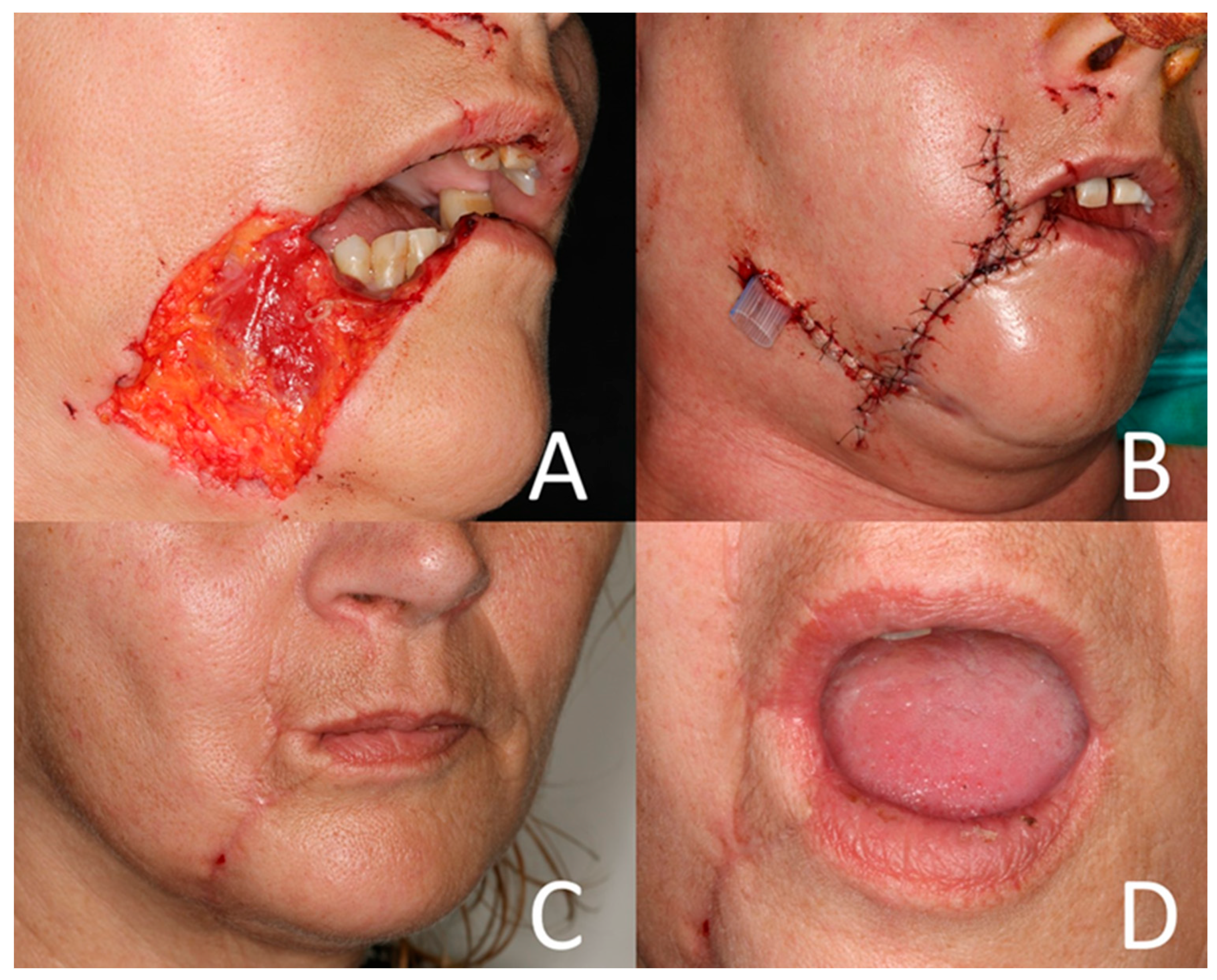 Facial Dog Bite Reconstruction