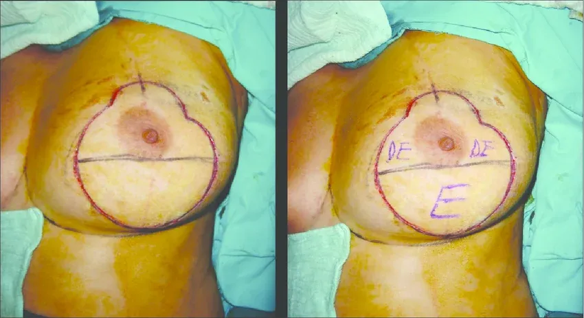The Snowman Pattern in Reduction Mammaplasty