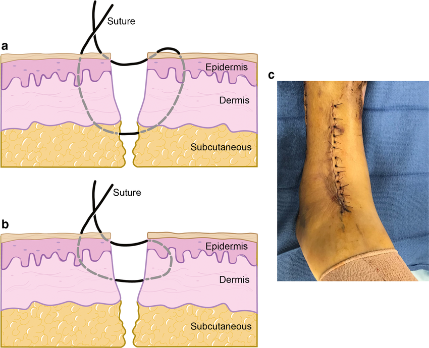 Donati vs Allgöwer-Donati Sutures