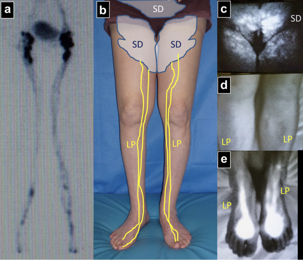 ICG Lymphography Patterns in Early Lymphatic Dysfunction