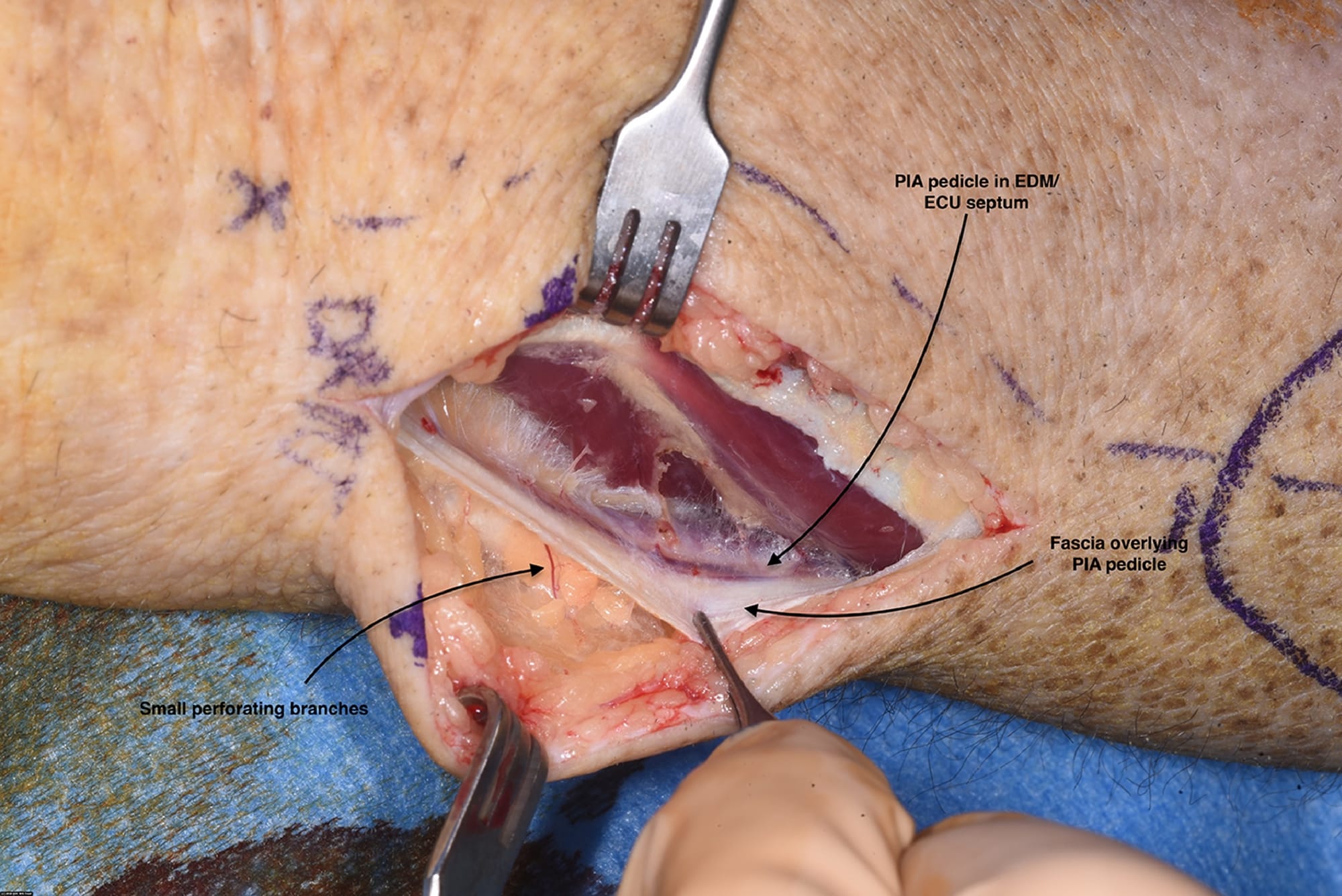 Posterior Interosseous Artery Flap Pedicle Identification