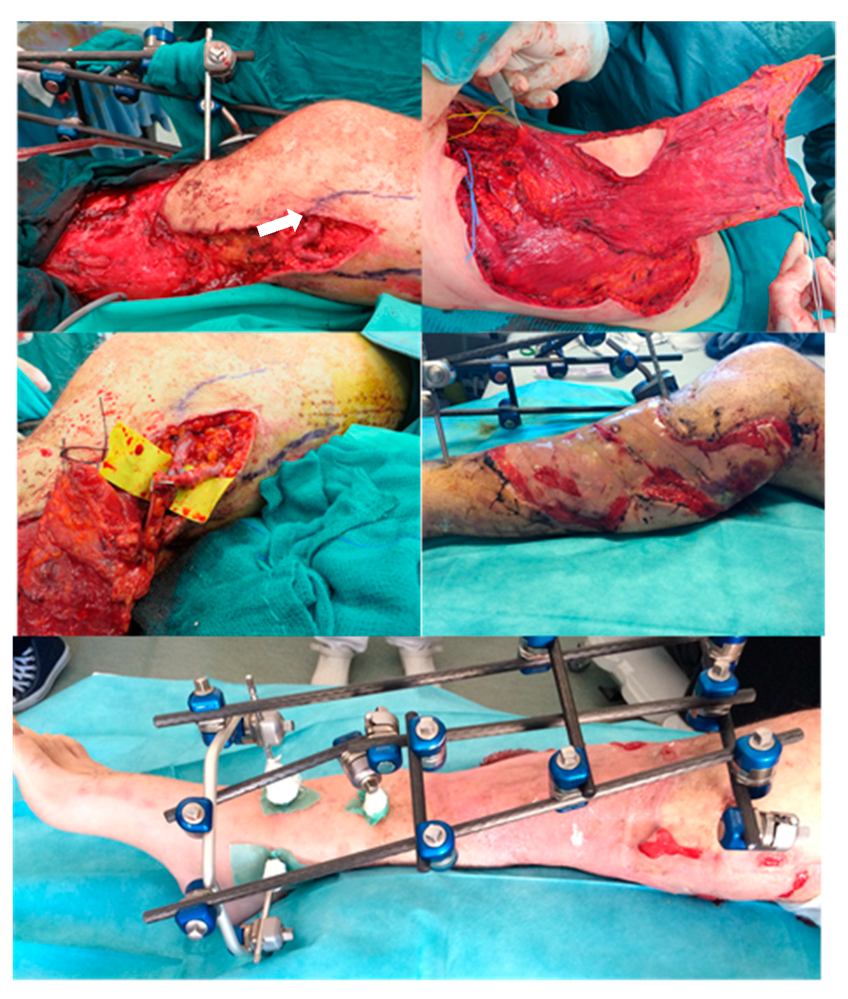 AV Loops in Limb Recon