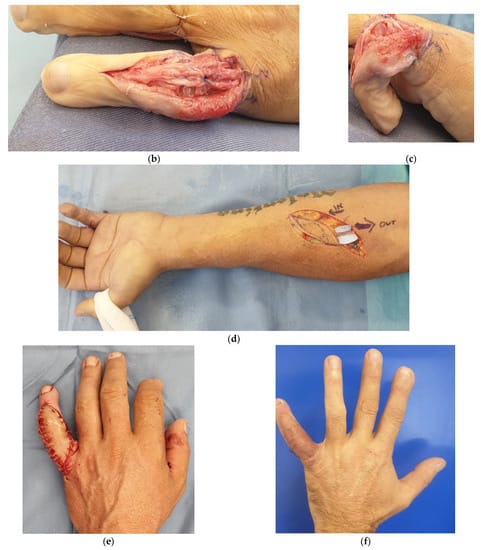 Retrograde Venous Flap for Dorsal Finger Reconstruction