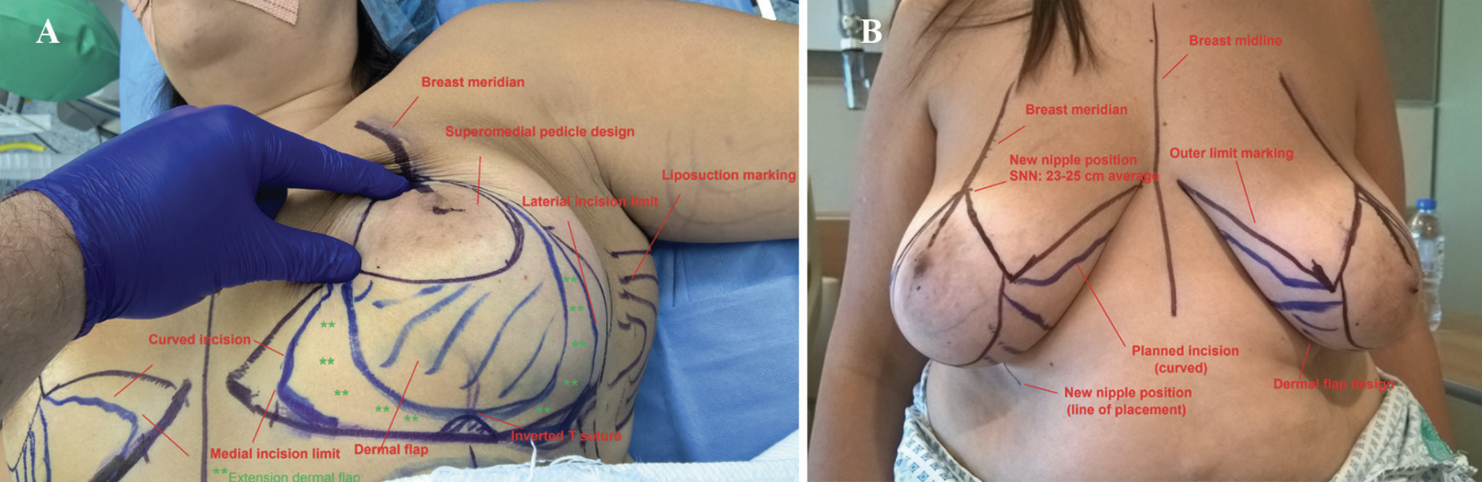 Breast Reduction Preoperative Markings 