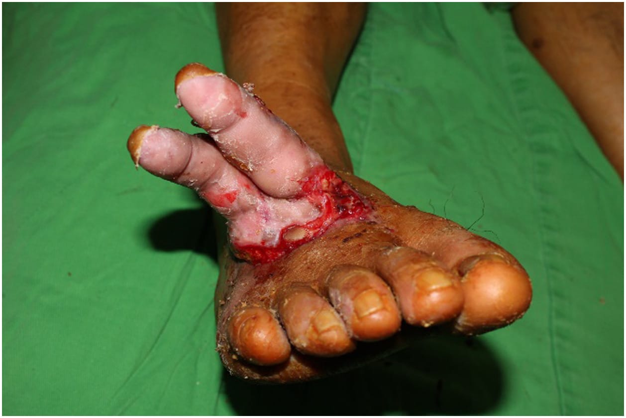 Ectopic multiple digit replantation salvage of hand torsion injury following anterolateral thigh perforator flap coverage
