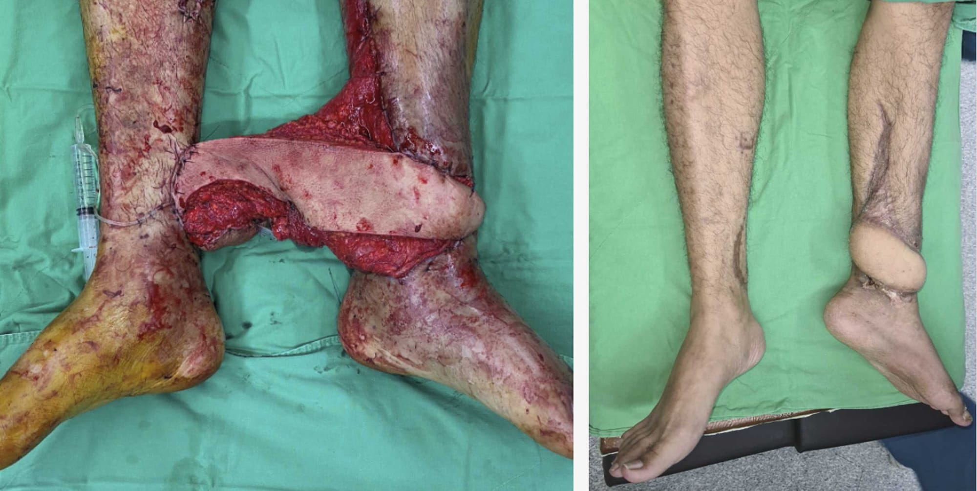 Recipient Vessel Selection for Vessel-Depleted Lower Limbs