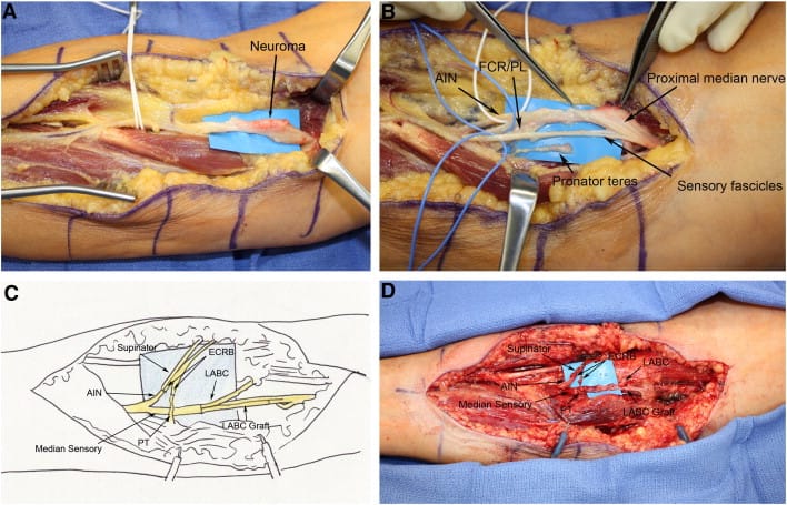 Management of Nerve Gaps