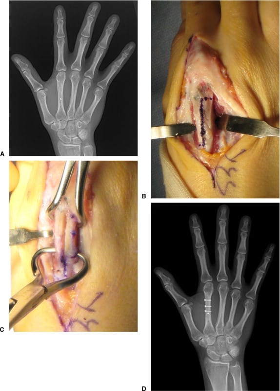 Metacarpal Fracture Fixing