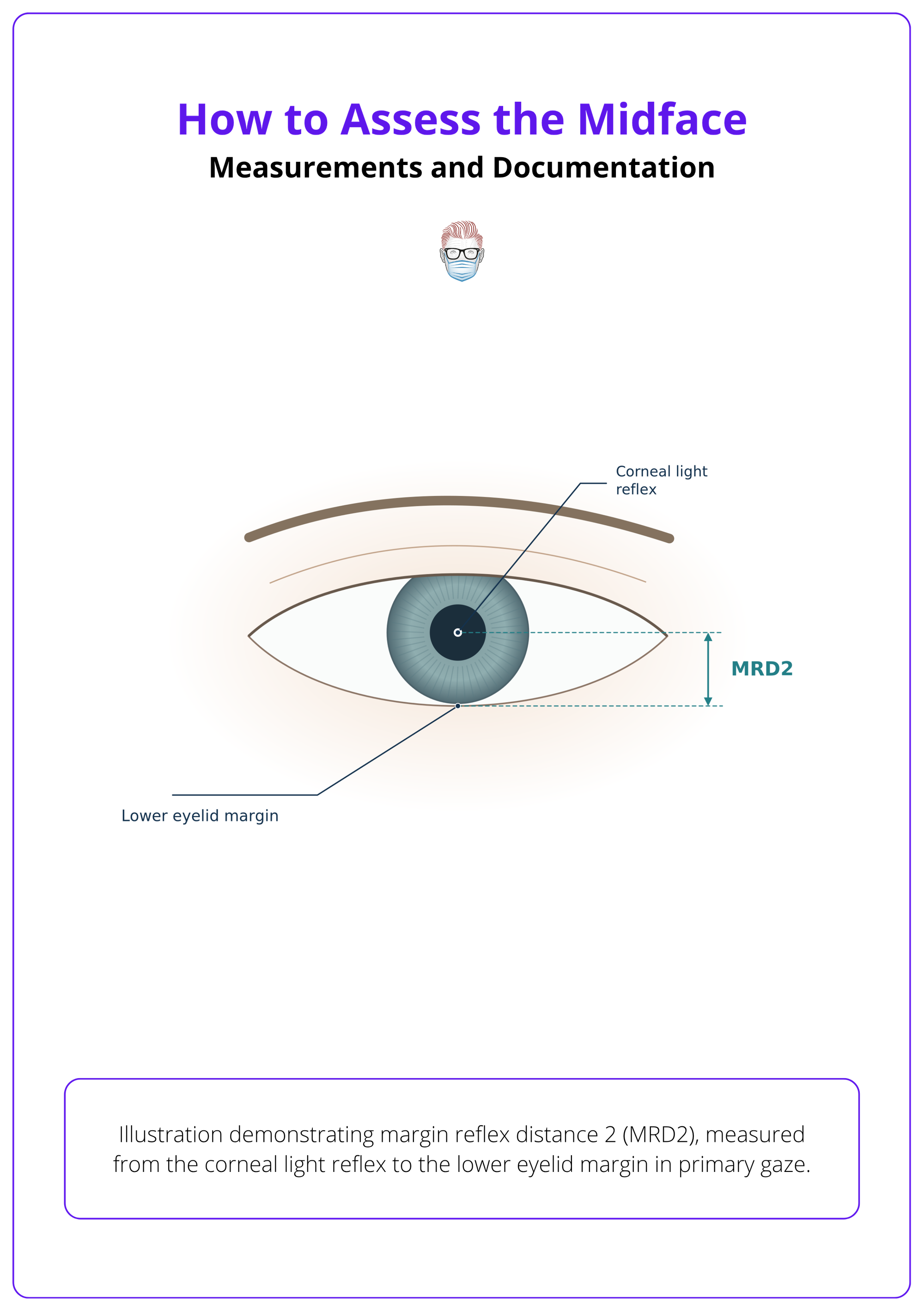 Margin reflex distance 2 (MRD2), measured from the corneal light reflex to the lower eyelid margin in primary gaze.