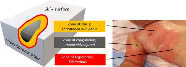 Jackson’s 3 Zones of Burn Injury