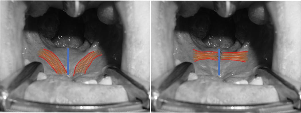 Revision Intravelar Veloplasty