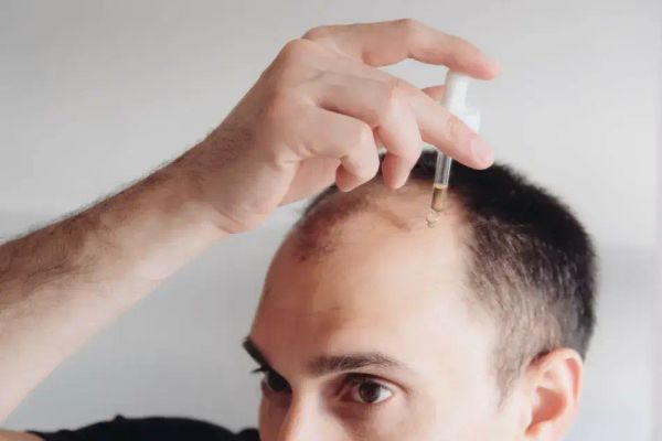 Best Hair Loss Treatments in 2025: What Really Works?