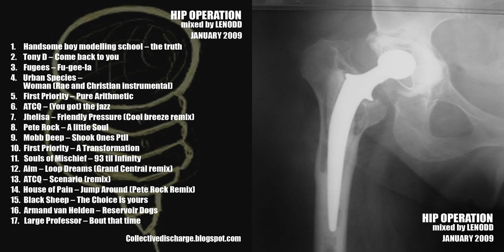 Lenodd - Hip Operation