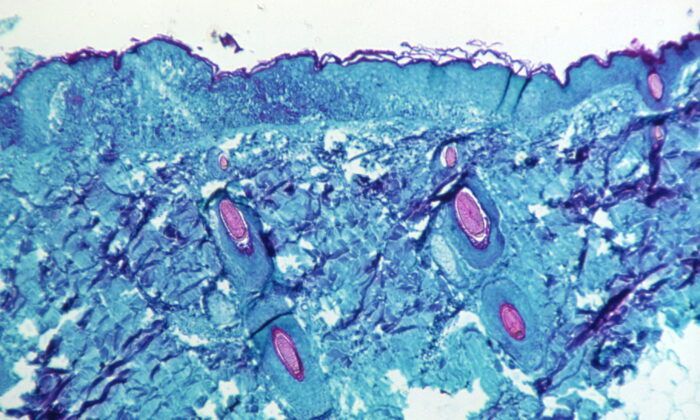 Peer-Reviewed Study Finds Monkeypox Primarily Transmitted Sexually by Men