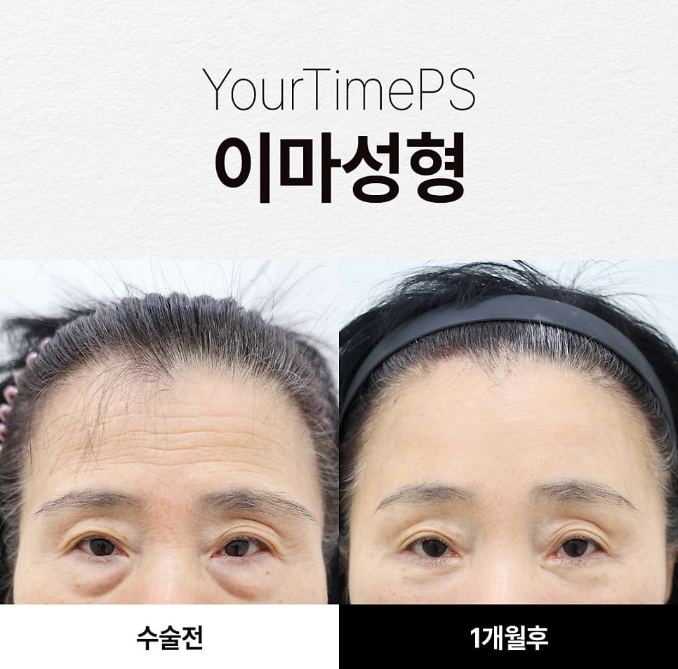 Forehead Lift Surgery: How Middle-Aged Patients Decide Whether They Need One
