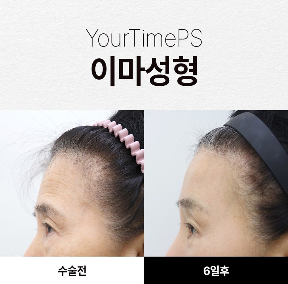 Forehead Lift Surgery: How Middle-Aged Patients Decide Whether They Need One — 2