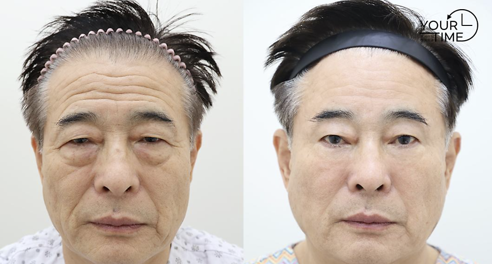 Forehead Lift Surgery: How Middle-Aged Patients Decide Whether They Need One — 3