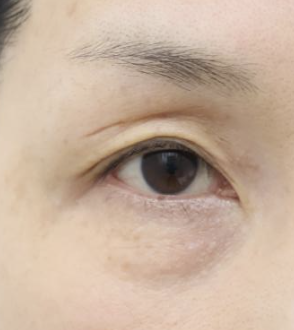[Caution: Surgical Images] Lower Eyelid Lift — The Actual Procedure, Step by Step — 2