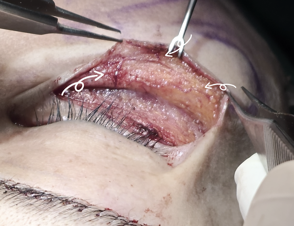 [Caution: Surgical Images] Lower Eyelid Lift — The Actual Procedure, Step by Step — 3