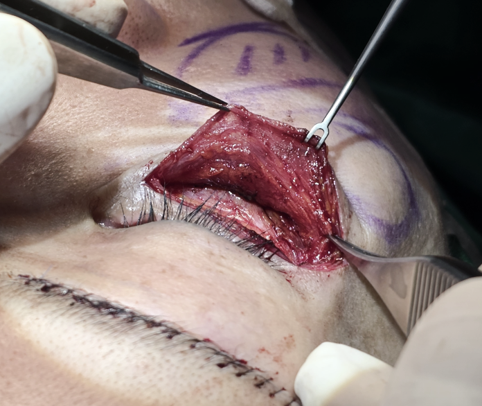 [Caution: Surgical Images] Lower Eyelid Lift — The Actual Procedure, Step by Step — 4