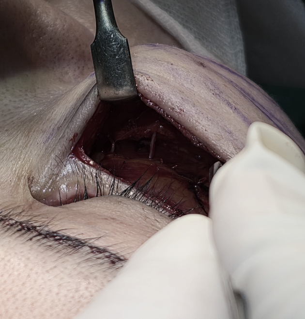 [Caution: Surgical Images] Lower Eyelid Lift — The Actual Procedure, Step by Step — 5