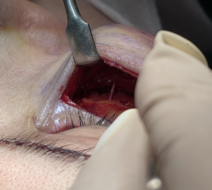 [Caution: Surgical Images] Lower Eyelid Lift — The Actual Procedure, Step by Step — 6