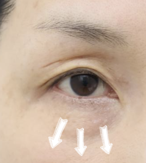 [Caution: Surgical Images] Lower Eyelid Lift — The Actual Procedure, Step by Step — 7