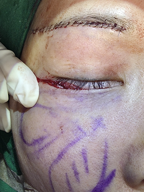 [Caution: Surgical Images] Lower Eyelid Lift — The Actual Procedure, Step by Step — 8