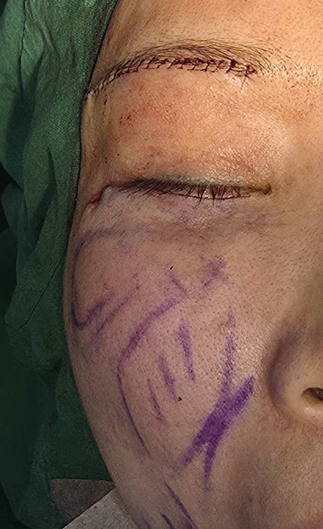 [Caution: Surgical Images] Lower Eyelid Lift — The Actual Procedure, Step by Step — 9