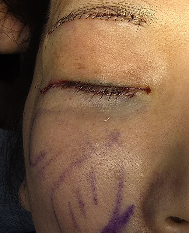 [Caution: Surgical Images] Lower Eyelid Lift — The Actual Procedure, Step by Step — 10