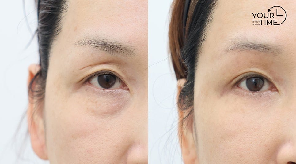 [Caution: Surgical Images] Lower Eyelid Lift — The Actual Procedure, Step by Step — 11