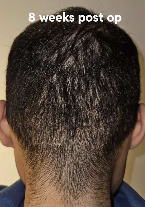 Hairline Lowering Surgery vs. Hair Transplant: Pros and Cons Compared — 2
